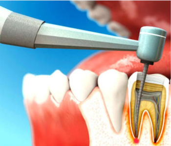 endodontics